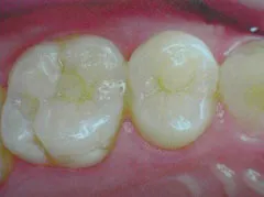 近年の虫歯治療